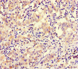 SMARCE1 / BAF57 Antibody - Immunohistochemistry of paraffin-embedded human lung cancer at dilution of 1:100