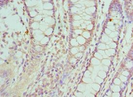 SMC1A / SMC1 Antibody - Immunohistochemistry of paraffin-embedded human rectal cancer using antibody at 1:100 dilution.