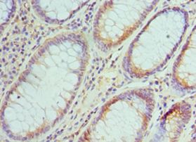 SMC1A / SMC1 Antibody - Immunohistochemistry of paraffin-embedded human colon cancer using antibody at 1:100 dilution.