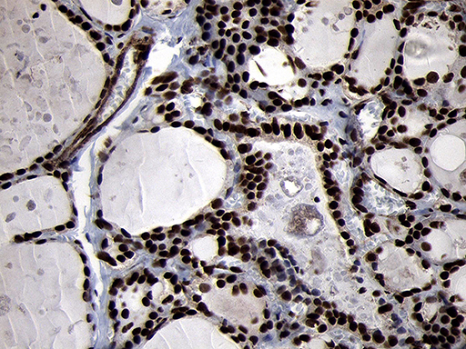 SMC1A / SMC1 Antibody - Immunohistochemical staining of paraffin-embedded Human thyroid tissue within the normal limits using anti-SMC1A mouse monoclonal antibody. (Heat-induced epitope retrieval by 1mM EDTA in 10mM Tris buffer. (pH8.5) at 120°C for 3 min. (1:1000)
