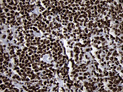 SMC1A / SMC1 Antibody - Immunohistochemical staining of paraffin-embedded Human lymphoma tissue using anti-SMC1A mouse monoclonal antibody. (Heat-induced epitope retrieval by 1mM EDTA in 10mM Tris buffer. (pH8.5) at 120°C for 3 min. (1:1000)