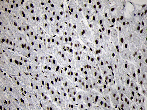 SMC1A / SMC1 Antibody - Immunohistochemical staining of paraffin-embedded Carcinoma of Human liver tissue using anti-SMC1A mouse monoclonal antibody. (Heat-induced epitope retrieval by 1mM EDTA in 10mM Tris buffer. (pH8.5) at 120°C for 3 min. (1:1000)