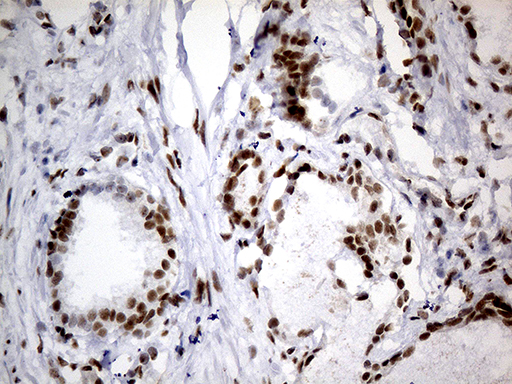 SMC1A / SMC1 Antibody - Immunohistochemical staining of paraffin-embedded Carcinoma of Human prostate tissue using anti-SMC1A mouse monoclonal antibody. (Heat-induced epitope retrieval by 1mM EDTA in 10mM Tris buffer. (pH8.5) at 120°C for 3 min. (1:500)