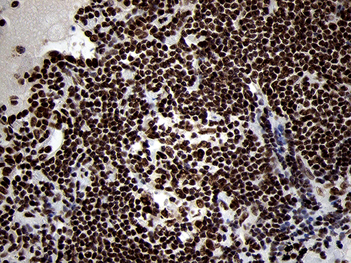SMC1A / SMC1 Antibody - Immunohistochemical staining of paraffin-embedded Carcinoma of Human lung tissue using anti-SMC1A mouse monoclonal antibody. (Heat-induced epitope retrieval by 1mM EDTA in 10mM Tris buffer. (pH8.5) at 120°C for 3 min. (1:500)