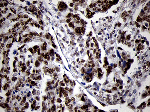 SMC1A / SMC1 Antibody - Immunohistochemical staining of paraffin-embedded Adenocarcinoma of Human ovary tissue using anti-SMC1A mouse monoclonal antibody. (Heat-induced epitope retrieval by 1mM EDTA in 10mM Tris buffer. (pH8.5) at 120°C for 3 min. (1:500)
