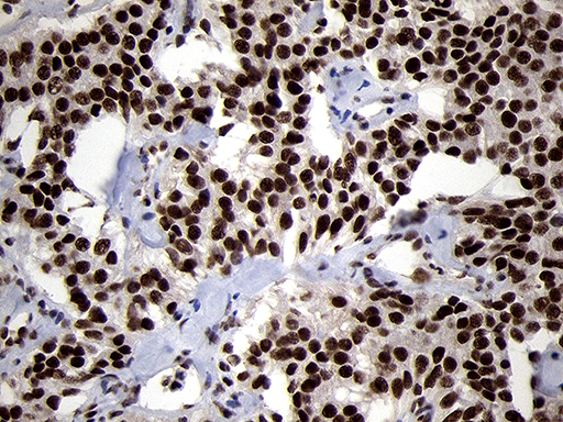 SMC1A / SMC1 Antibody - Immunohistochemical staining of paraffin-embedded Carcinoma of Human pancreas tissue using anti-SMC1A mouse monoclonal antibody. (Heat-induced epitope retrieval by 1mM EDTA in 10mM Tris buffer. (pH8.5) at 120°C for 3 min. (1:500)