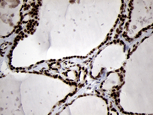 SMC1A / SMC1 Antibody - Immunohistochemical staining of paraffin-embedded Human thyroid tissue within the normal limits using anti-SMC1A mouse monoclonal antibody. (Heat-induced epitope retrieval by 1mM EDTA in 10mM Tris buffer. (pH8.5) at 120°C for 3 min. (1:500)