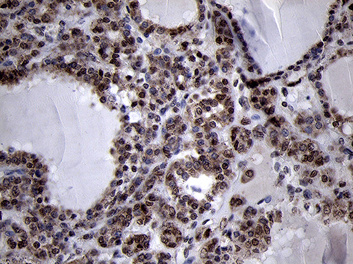 SMC1A / SMC1 Antibody - Immunohistochemical staining of paraffin-embedded Carcinoma of Human thyroid tissue using anti-SMC1A mouse monoclonal antibody. (Heat-induced epitope retrieval by 1mM EDTA in 10mM Tris buffer. (pH8.5) at 120°C for 3 min. (1:500)