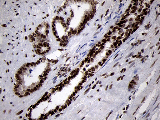 SMC1A / SMC1 Antibody - Immunohistochemical staining of paraffin-embedded Carcinoma of Human prostate tissue using anti-SMC1A mouse monoclonal antibody. (Heat-induced epitope retrieval by 1mM EDTA in 10mM Tris buffer. (pH8.5) at 120°C for 3 min. (1:500)