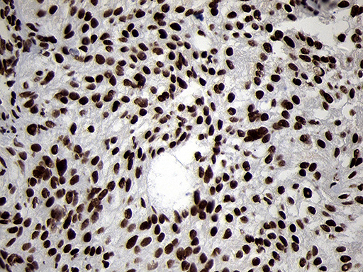 SMC1A / SMC1 Antibody - Immunohistochemical staining of paraffin-embedded Carcinoma of Human liver tissue using anti-SMC1A mouse monoclonal antibody. (Heat-induced epitope retrieval by 1mM EDTA in 10mM Tris buffer. (pH8.5) at 120°C for 3 min. (1:500)