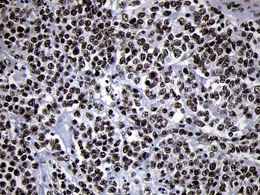 SMC1A / SMC1 Antibody - Immunohistochemical staining of paraffin-embedded Human lymphoma tissue using anti-SMC1A mouse monoclonal antibody. (Heat-induced epitope retrieval by 1mM EDTA in 10mM Tris buffer. (pH8.5) at 120°C for 3 min. (1:500)