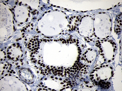 SMC1A / SMC1 Antibody - Immunohistochemical staining of paraffin-embedded Human thyroid tissue within the normal limits using anti-SMC1A mouse monoclonal antibody. (Heat-induced epitope retrieval by 1mM EDTA in 10mM Tris buffer. (pH8.5) at 120°C for 3 min. (1:500)