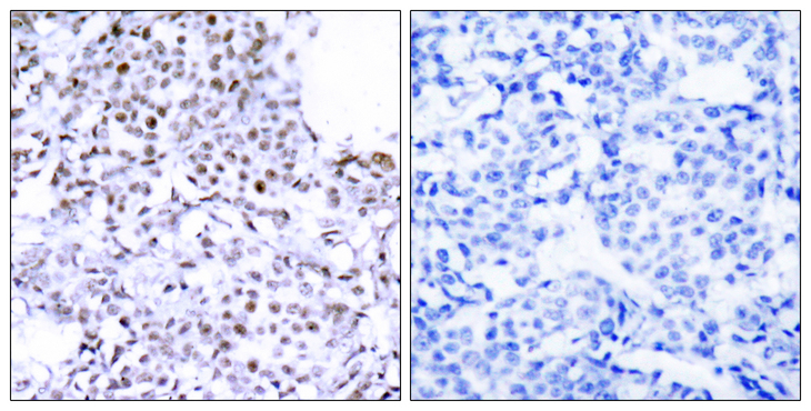 SMC1A / SMC1 Antibody - Immunohistochemistry analysis of paraffin-embedded human breast carcinoma tissue, using SMC1 Antibody. The picture on the right is blocked with the synthesized peptide.