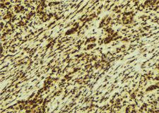 SMC1A / SMC1 Antibody - 1:100 staining human breast carcinoma tissue by IHC-P. The sample was formaldehyde fixed and a heat mediated antigen retrieval step in citrate buffer was performed. The sample was then blocked and incubated with the antibody for 1.5 hours at 22°C. An HRP conjugated goat anti-rabbit antibody was used as the secondary.