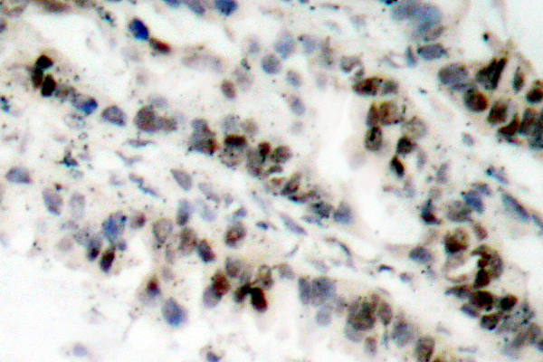 SMC1A / SMC1 Antibody - IHC of p-SMC1 (S957) pAb in paraffin-embedded human lung carcinoma tissue.