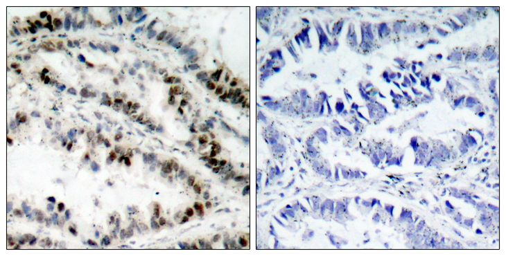 SMC1A / SMC1 Antibody - Immunohistochemistry analysis of paraffin-embedded human lung carcinoma, using SMC1 (Phospho-Ser957) Antibody. The picture on the right is blocked with the phospho peptide.