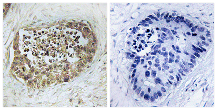 SMC1A / SMC1 Antibody - Immunohistochemistry analysis of paraffin-embedded human lung carcinoma, using SMC1 (Phospho-Ser966) Antibody. The picture on the right is blocked with the phospho peptide.