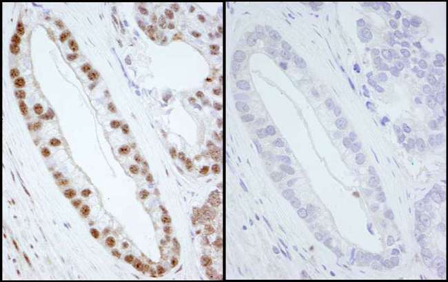 SMC1A / SMC1 Antibody - Detection of Human Phospho SMC1 (Ser 966) by Immunohistochemistry. Samples: FFPE sections of human prostate carcinoma. Mock treatment (left panel) or lambda phosphatase-treatment (right panel). Antibody: Affinity purified rabbit anti-Phospho-SMC1 (Ser 966) used at a dilution of 1:250. Detection: DAB.