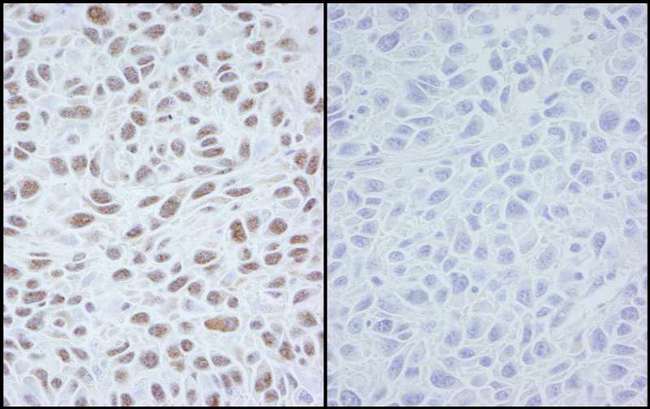 SMC1A / SMC1 Antibody - Detection of Mouse Phospho SMC1 (Ser 966) by Immunohistochemistry. Samples: FFPE sections of mouse squamous cell carcinoma. Mock treatment (left panel) or lambda phosphatase-treatment (right panel). Antibody: Affinity purified rabbit anti-Phospho-SMC1 (Ser 966) used at a dilution of 1:250. Detection: DAB.