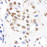 SMC1A / SMC1 Antibody - Detection of Human Phospho SMC1 (S966) by Immunohistochemistry. Sample: FFPE section of human breast carcinoma. Antibody: Affinity purified rabbit anti-Phospho SMC1 (S966) used at a dilution of 1:1000 (1 ug/ml). Detection: DAB.