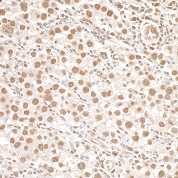 SMC1A / SMC1 Antibody - Detection of human Phospho SMC1 (S966) by immunohistochemistry. Sample: FFPE section of human testicular seminoma. Antibody: Affinity purified rabbit anti- Phospho SMC1 (S966) used at a dilution of 1:1,000 (1µg/ml). Detection: DAB