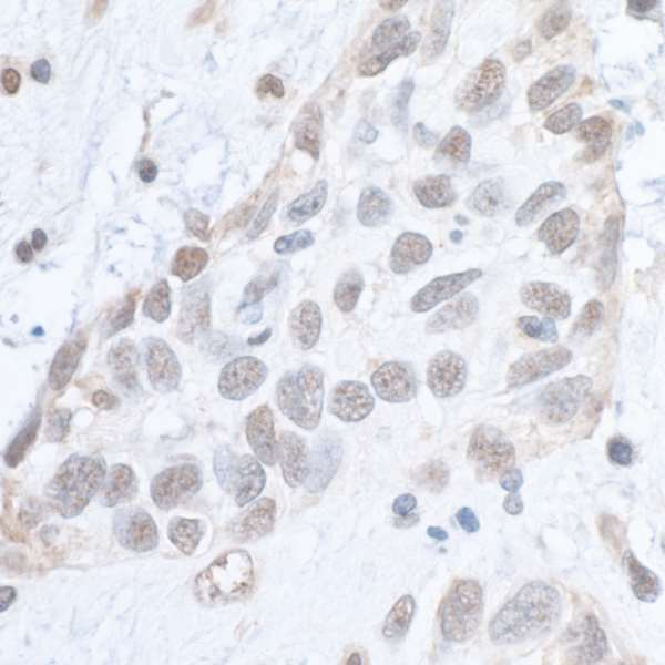 SMC1A / SMC1 Antibody - Detection of human Phospho SMC1 (S966) by immunohistochemistry. Sample: FFPE section of human breast carcinoma. Antibody: Affinity purified rabbit anti- Phospho SMC1 (S966) used at a dilution of 1:1,000 (1µg/ml). Detection: DAB