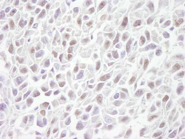SMC3 / HCAP Antibody - Detection of Mouse SMC3 by Immunohistochemistry. Sample: FFPE section of mouse squamous cell carcinoma. Antibody: Affinity purified rabbit anti-SMC3 used at a dilution of 1:250. Detection: DAB.