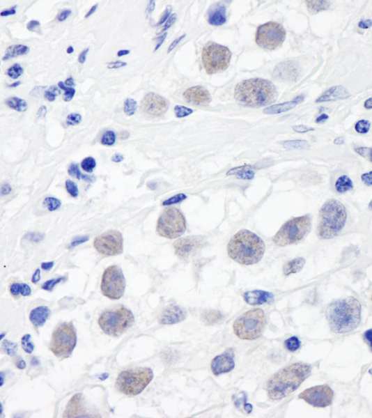 SMC3 / HCAP Antibody - Detection of Human SMC3 by Immunohistochemistry. Sample: FFPE section of human testicular seminoma. Antibody: Affinity purified rabbit anti-SMC3 used at a dilution of 1:1000 (1 ug/ml). Detection: DAB.