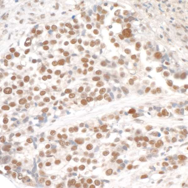 SMC3 / HCAP Antibody - Detection of human SMC3 by immunohistochemistry. Sample: FFPE section of human lung carcinoma. Antibody: Affinity purified rabbit anti-SMC3 used at 1:1,000 (1µg/ml). Detection: DAB