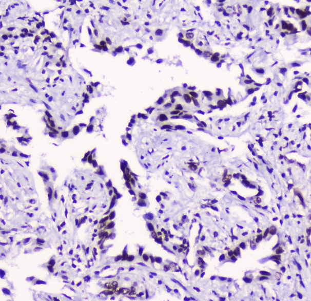 SMC3 / HCAP Antibody - IHC analysis of SMC3 using anti-SMC3 antibody. SMC3 was detected in paraffin-embedded section of human lung cancer tissue. Heat mediated antigen retrieval was performed in citrate buffer (pH6, epitope retrieval solution) for 20 mins. The tissue section was blocked with 10% goat serum. The tissue section was then incubated with 2µg/ml mouse anti-SMC3 antibody overnight at 4°C. Biotinylated goat anti-mouse IgG was used as secondary antibody and incubated for 30 minutes at 37°C. The tissue section was developed using Strepavidin-Biotin-Complex (SABC) with DAB as the chromogen.