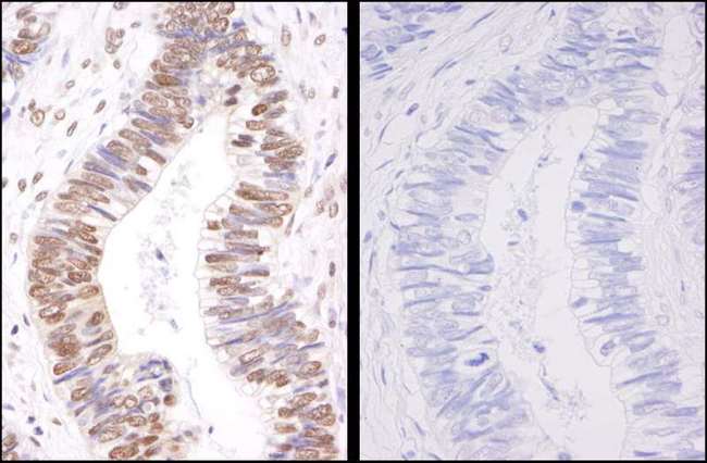 SMC3 / HCAP Antibody - Detection of Human Phospho-SMC3 (S1083) by Immunohistochemistry. Samples: FFPE serial sections of human colon adenocarcinoma. Mock phosphatase treated section (left) or calf intestinal phosphatase-treated section (right) immunostained for Phospho-SMC3. Antibody: Affinity purified rabbit anti-Phospho-SMC3 (S1083) used at a dilution of 1:250. Detection: DAB staining using anti-rabbit IHC Antibody at a dilution of 1:100.