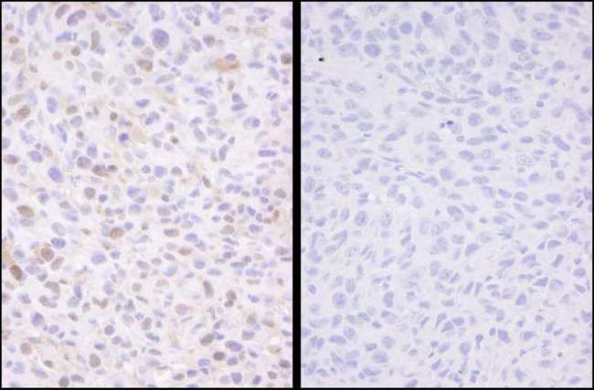 SMC3 / HCAP Antibody - Detection of Mouse Phospho-SMC3 (S1083) by Immunohistochemistry. Samples: FFPE serial sections of mouse squamous cell carcinoma. Mock phosphatase treated section (left) or calf intestinal phosphatase-treated section (right) immunostained for Phospho-SMC3. Antibody: Affinity purified rabbit anti-Phospho-SMC3 (S1083) used at a dilution of 1:250. Detection: DAB staining using anti-rabbit IHC Antibody at a dilution of 1:100.