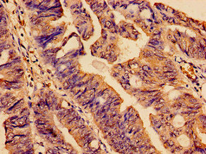 SMC4 Antibody - Immunohistochemistry analysis of human colon cancer at a dilution of 1:100