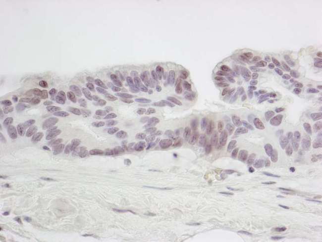 SMC6 Antibody - Detection of Human SMC6 by Immunohistochemistry. Sample: FFPE section of human ovarian tumor. Antibody: Affinity purified rabbit anti-SMC6 used at a dilution of 1:250.