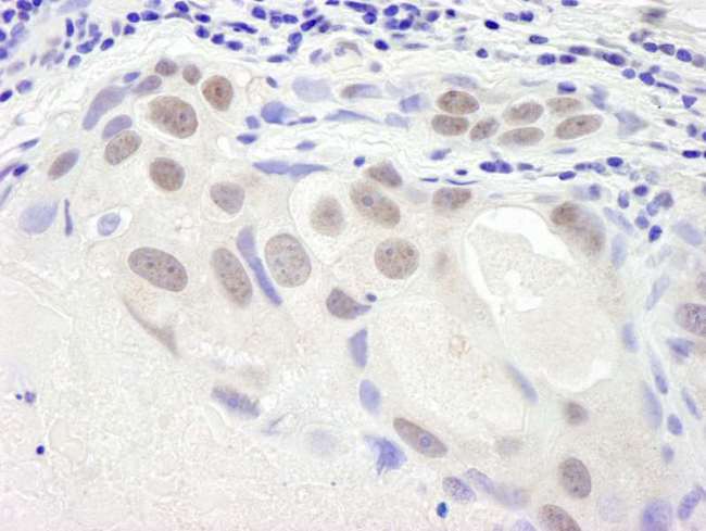 SMC6 Antibody - Detection of Human SMC6 by Immunohistochemistry. Sample: FFPE section of human breast tumor. Antibody: Affinity purified rabbit anti-SMC6 used at a dilution of 1:250.