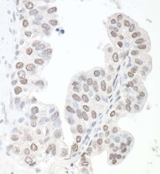 SMC6 Antibody - Detection of human SMC6 by immunohistochemistry. Sample: FFPE section of prostate carcinoma. Antibody: Rabbit anti-SMC6 antibody ((A120-501P).