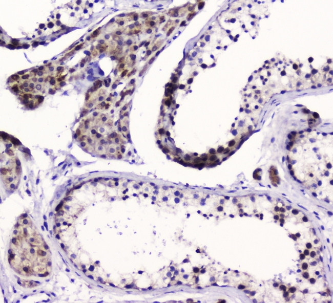 SMC6 Antibody - IHC analysis of SMC6L1 using anti-SMC6L1 antibody. SMC6L1 was detected in paraffin-embedded section of human testis tissue. Heat mediated antigen retrieval was performed in citrate buffer (pH6, epitope retrieval solution) for 20 mins. The tissue section was blocked with 10% goat serum. The tissue section was then incubated with 1ugµg/ml rabbit anti-SMC6L1 Antibody overnight at 4°C. Biotinylated goat anti-rabbit IgG was used as secondary antibody and incubated for 30 minutes at 37°C. The tissue section was developed using Strepavidin-Biotin-Complex (SABC) with DAB as the chromogen.