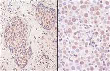 SMCHD1 Antibody - Detection of Human SmcHD1 by Immunohistochemistry. Sample: FFPE section of human non-small cell lung cancer (left) and testicular seminoma (right). Antibody: Affinity purified rabbit anti-SmcHD1 used at a dilution of 1:200 (1 ug/ml). Detection: Vector Laboratories ImmPACT NovaRED Peroxidase Substrate.
