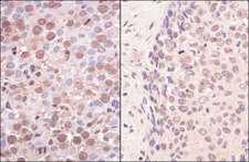SMCHD1 Antibody - Detection of Human SmcHD1 by Immunohistochemistry. Sample: FFPE section of human testicular seminoma (left) and non-small cell lung cancer (right). Antibody: Affinity purified rabbit anti-SmcHD1 used at a dilution of 1:200 (1 ug/ml). Detection: Vector Laboratories ImmPACT NovaRED Peroxidase Substrate.