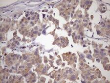 SMCP Antibody - Immunohistochemical staining of paraffin-embedded Carcinoma of Human bladder tissue using anti-SMCP mouse monoclonal antibody. (Heat-induced epitope retrieval by 1mM EDTA in 10mM Tris buffer. (pH8.5) at 120 oC for 3 min. (1:150)