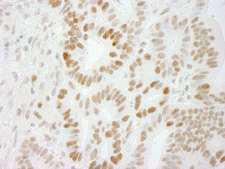 SMEK1 Antibody - Detection of Human PPP4R3 Alpha by Immunohistochemistry. Sample: FFPE section of human stomach carcinoma. Antibody: Affinity purified rabbit anti-PPP4R3 Alpha used at a dilution of 1:250. Epitope Retrieval Buffer-High pH (IHC-101J) was substituted for Epitope Retrieval Buffer-Reduced pH.