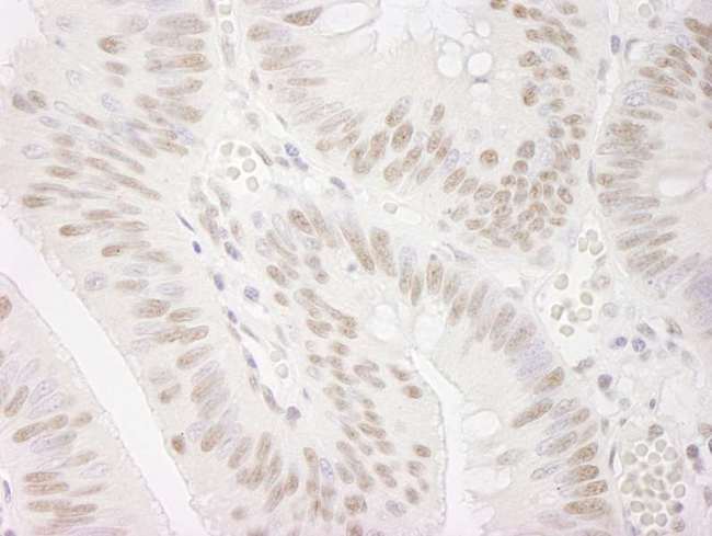 SMEK1 Antibody - Detection of Human PPP4R3 Alpha by Immunohistochemistry. Sample: FFPE section of human colon carcinoma. Antibody: Affinity purified rabbit anti-PPP4R3 Alpha used at a dilution of 1:250. Epitope Retrieval Buffer-High pH (IHC-101J) was substituted for Epitope Retrieval Buffer-Reduced pH.