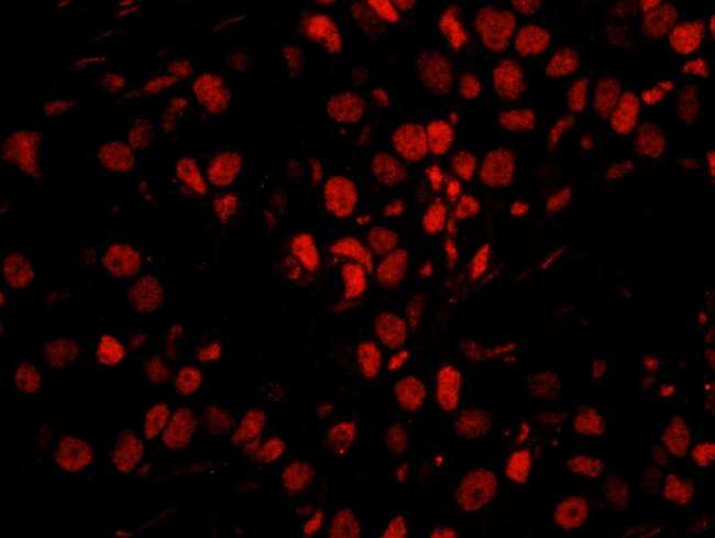SMEK1 Antibody - Detection of Human PPP4R3 Alpha by Immunofluorescence. Sample: FFPE section of human breast carcinoma. Antibody: Affinity purified rabbit anti-PPP4R3 Alpha used at a dilution of 1:250. Detection: Red-fluorescent goat anti-rabbit IgG highly cross-adsorbed used at a dilution of 1:100. Epitope Retrieval Buffer-High pH (IHC-101J) was substituted for Epitope Retrieval Buffer-Reduced pH.