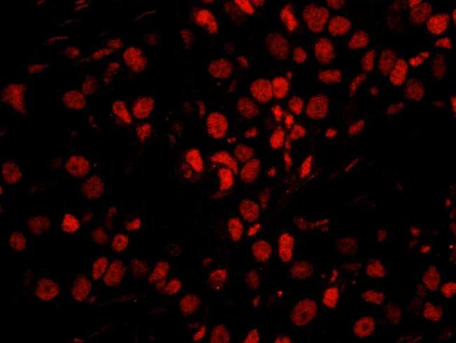 SMEK1 Antibody - Detection of human PPP4R3 Alpha by immunohistochemistry. Sample: FFPE section of human breast carcinoma. Antibody: Affinity purified rabbit anti-PPP4R3 Alpha used at a dilution of 1:250. Detection: Red-fluorescent goat anti-rabbit IgG highly cross-adsorbed Antibody used at a dilution of 1:100.