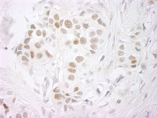 SMEK2 Antibody - Detection of Human PPP4R3 Beta by Immunohistochemistry. Sample: FFPE section of human breast carcinoma. Antibody: Affinity purified rabbit anti-PPP4R3 Beta used at a dilution of 1:250. Epitope Retrieval Buffer-High pH (IHC-101J) was substituted for Epitope Retrieval Buffer-Reduced pH.