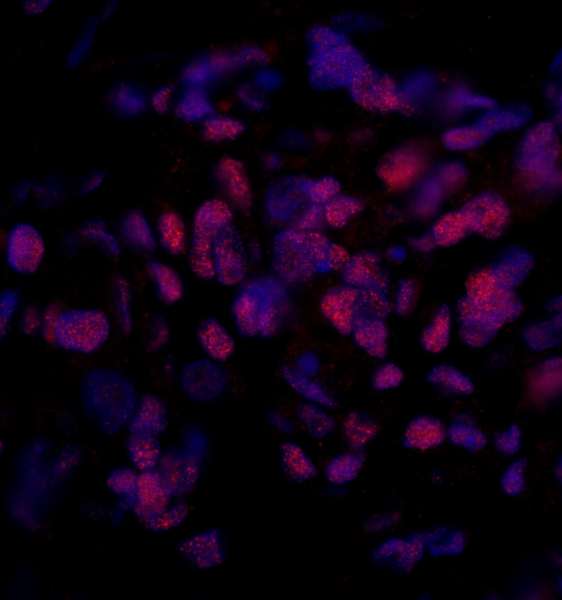 SMEK2 Antibody - Detection of Human PPP4R3 Beta by Immunohistochemistry. Sample: FFPE section of human breast carcinoma. Antibody: Affinity purified rabbit anti-PPP4R3 Beta used at a dilution of 1:100. Detection: Red-fluorescent goat anti-rabbit IgG highly cross-adsorbed Antibody used at a dilution of 1:100. Epitope Retrieval Buffer-High pH (IHC-101J) was substituted for Epitope Retrieval Buffer-Reduced pH.