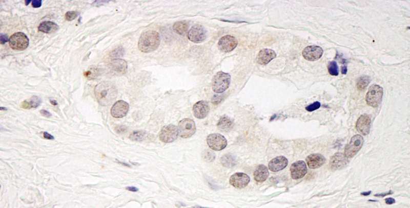SMEK2 Antibody - Detection of Human PPP4R3 Beta by Immunohistochemistry. Sample: FFPE section of human prostate carcinoma. Antibody: Affinity purified rabbit anti-PPP4R3 Beta used at a dilution of 1:200 (1 ug/ml). Detection: DAB.