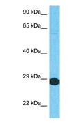 SMEK2 Antibody - Western blot of P4R3B Antibody with human Stomach Tumor lysate.  This image was taken for the unconjugated form of this product. Other forms have not been tested.