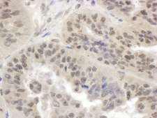 SMG1 / ATX Antibody - Detection of Human SMG1 by Immunohistochemistry. Sample: FFPE section of human ovarian carcinoma. Antibody: Affinity purified rabbit anti-SMG1 used at a dilution of 1:500 (2 ug/ml). Detection: DAB.