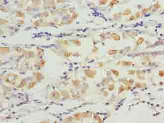 SMG6 Antibody - Immunohistochemistry of paraffin-embedded human gastric cancer using antibody at dilution of 1:100.